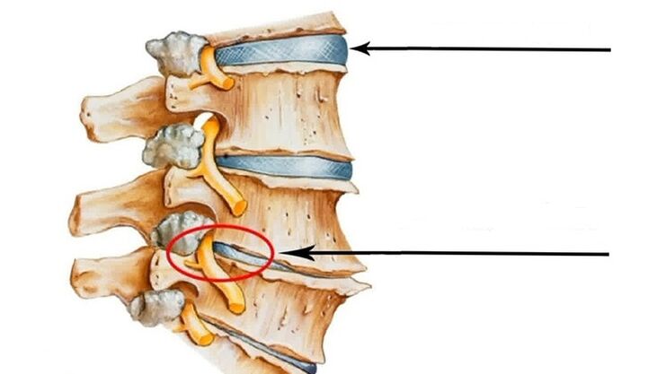 spinal injury in case of cervical osteochondrosis