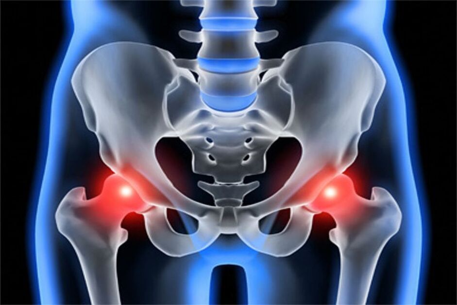 Deforming osteoarthritis of the hip joints (coxarthrosis)