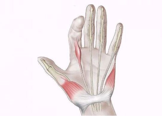 inflammation of the tendons as a cause of pain in the joints of the fingers