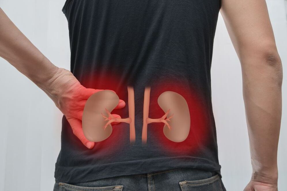 inflammation of the kidneys as a cause of back pain