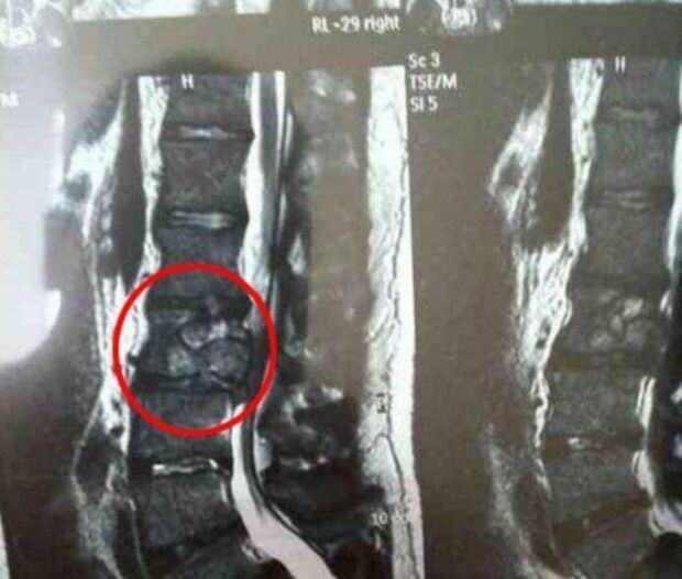 spinal tumor as a cause of back pain