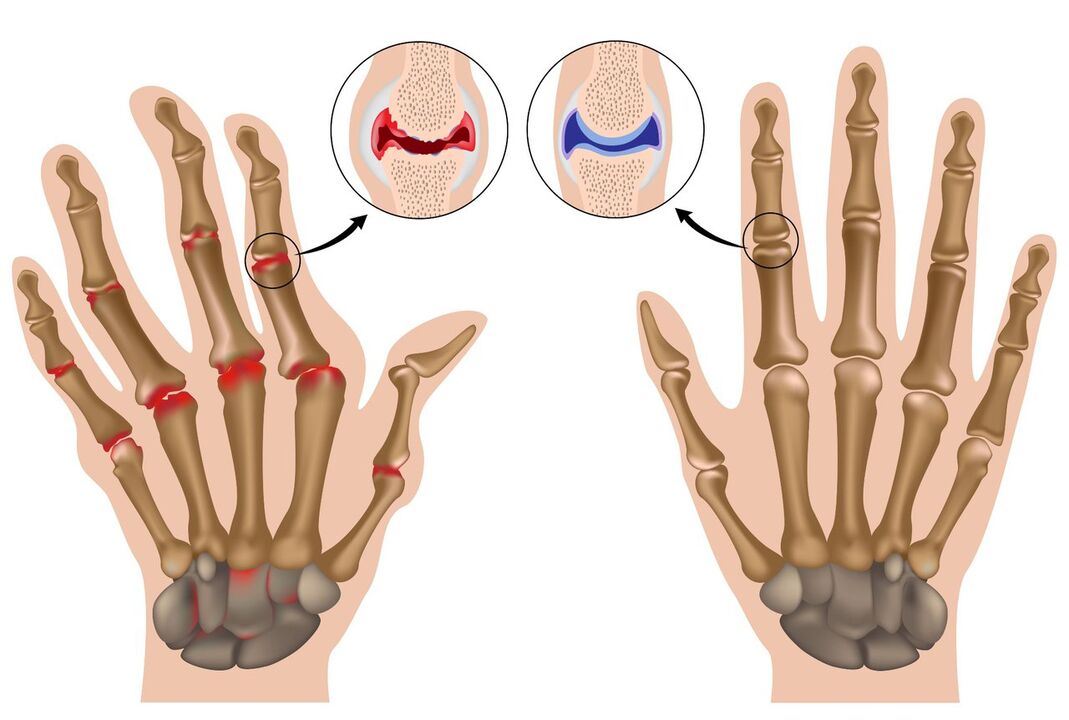 Hand joints healthy and affected by polyarthritis