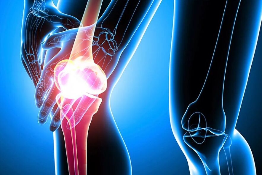 Osteoarthritis of the knee