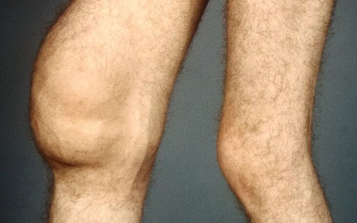 Post osteoarthritis -traumatic of the knee joint