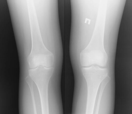 The radiography of the knee joint