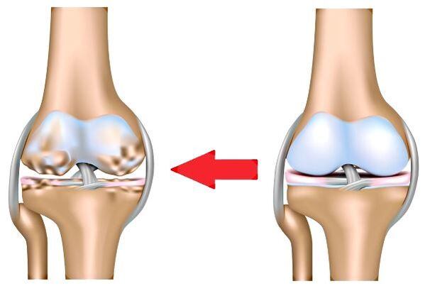Healthy and arthrosis joint