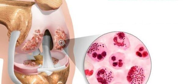 which leads to the development of osteoarthritis