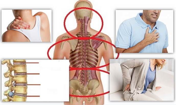 Places of illness for osteochondosis