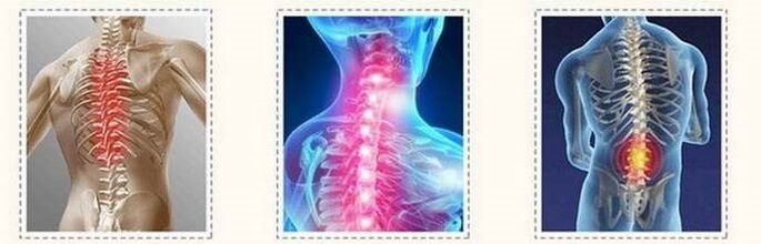 Spinal injuries of the osteochondrosis