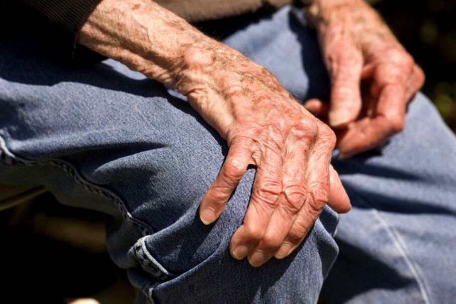 Osteoarthritis is an age-related disease that affects older people